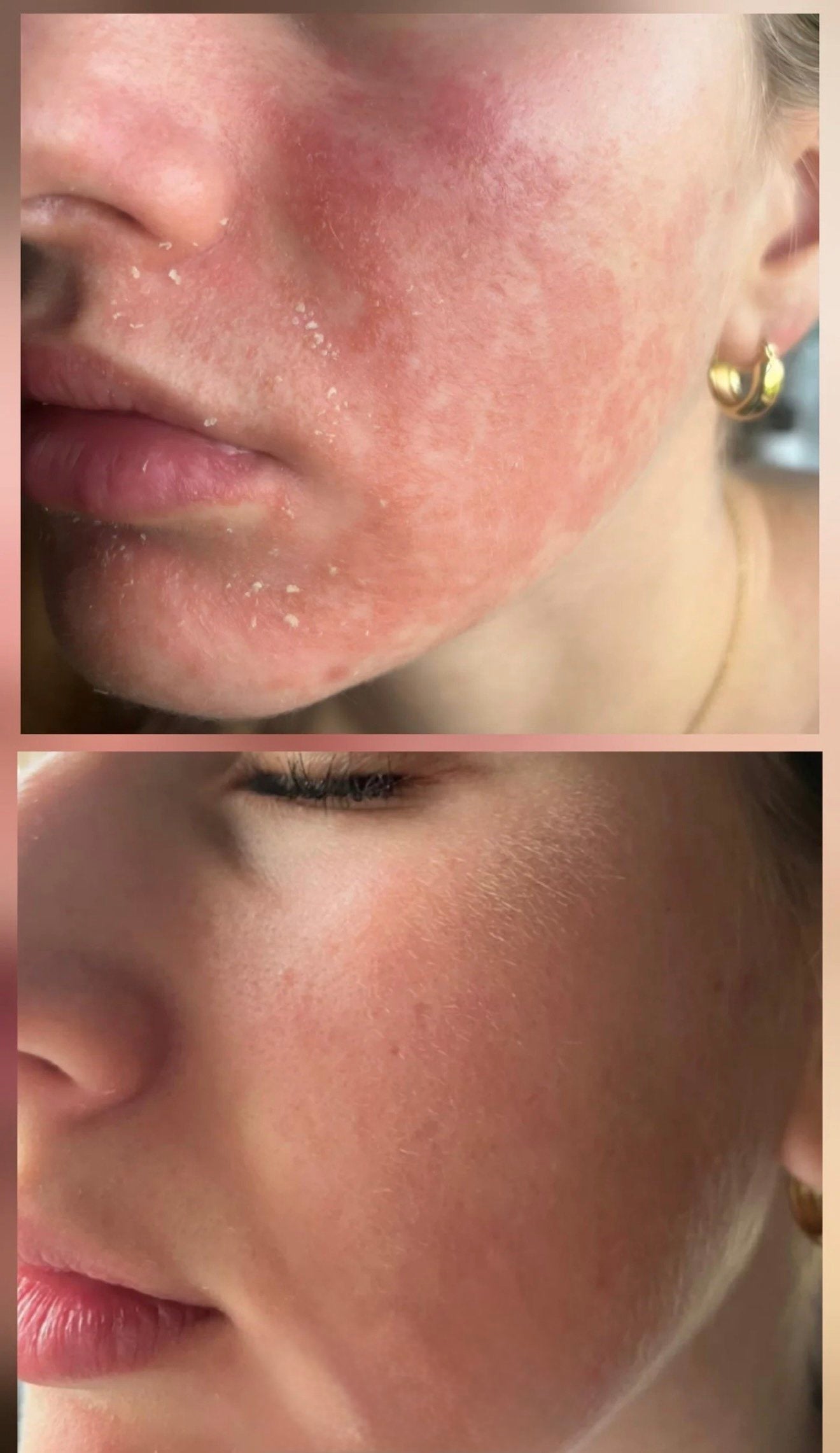 Miracletox Angelto Cream